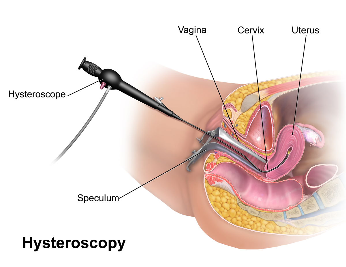 Hysteroscopy Procedure