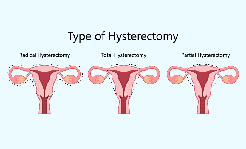 Radical Hysterectomy