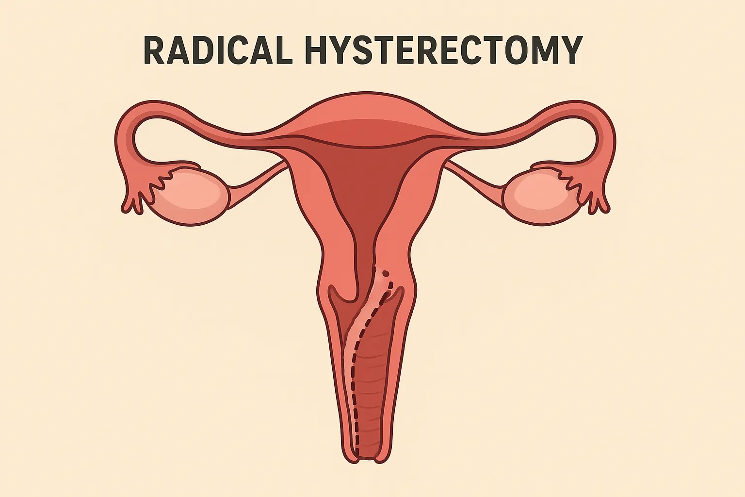 https://gyneonco.com/radical-hysterectomy-recovery-fertility-sexual-health/