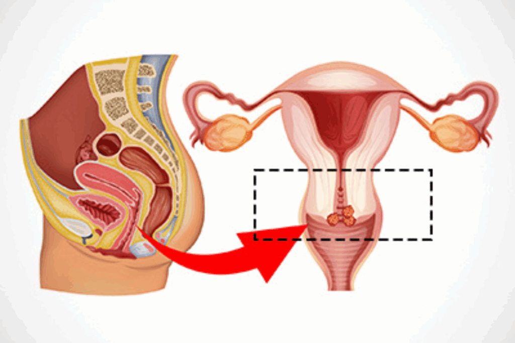 Critical Procedure for Treating Cervical Cancer
